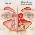 Nasal Congestion Treatments