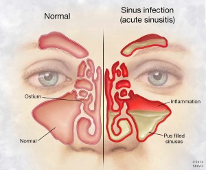 Nasal Congestion Treatments