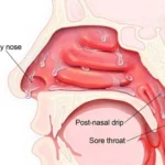 Nasal Congestion Treatments