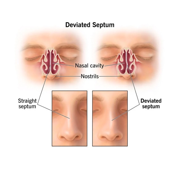 Can Nasal Congestion Treatments Prevent Recurrent Blockage