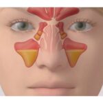 What Nasal Congestion Treatments Mean For Sinus Health